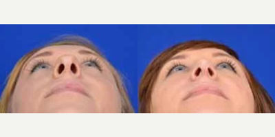 Woman treated with Rhinoplasty - Woman treated with Rhinoplasty
