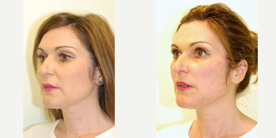 45-54 year old woman treated with Ellanse - Ellanse will stimulate your own natural collagen and maintain results for up to 1-4 years depending on which of the Ellanse products are used.