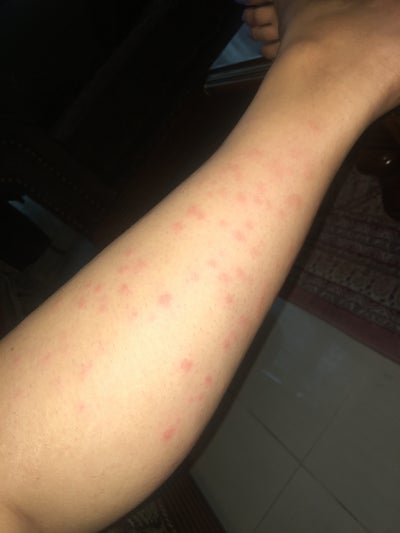 What Caused my Red Itchy Bumps/rash on my Legs After my ...