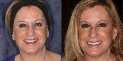 Woman treated with Da Vinci Veneers - Patient had square, chipped, discolored, rotated and poorly shaped teeth. Teeth restored with DaVinci veneers and 3/4 porcelain crowns.