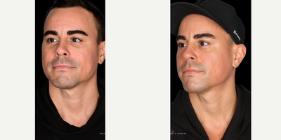 35-44 year old man treated with PCA Skin Peel - Five treatments of WIQO Peel