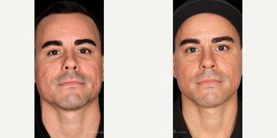 35-44 year old man treated with PCA Skin Peel - Five treatments of WIQO Peel