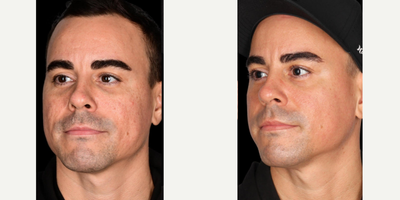 35-44 year old man treated with PCA Skin Peel - Five treatments of WIQO Peel
