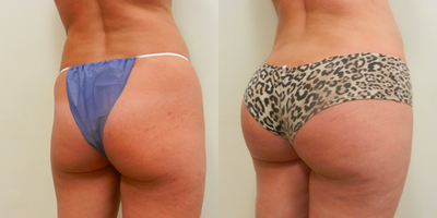 35-44 year old woman treated with Bilateral, Intramuscular Gluteal Implants (Butt Implants). - 35-44 year old woman treated with Bilateral, Intramuscular Gluteal Implants (Butt Implants).