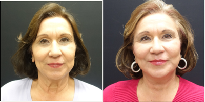 65-74 year old woman treated with Fat Transfer and Facelift - The patient underwent a high lateral SMAS face and necklift. The SMAS elevation supports the facelift so that their is minimal tension on the skin and enhance the possible longevity of the face and necklift. Along with the face and necklift she also had fat transfer to the face. Fat was transferred tough out the face and temples to restore the volume she has lost over time as we age. The combination of tightening and filling of the face gives her a much more youthful but natural appearance. This pictures show her two month result.