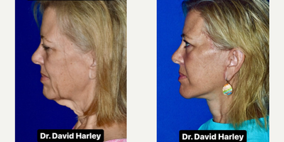 Woman treated with Facelift, Neck Lift - Everyone wants to look better and younger. But not at the cost of appearing unusual or unnatural.With extended deep plane face lifting techniques, the results are always natural and never over-done. This is because the deep tissues are lifted together with the superficial tissues in a single composite unit.This procedure is performed under local anesthesia.