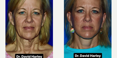 Woman treated with Facelift, Neck Lift - Everyone wants to look better and younger. But not at the cost of appearing unusual or unnatural.With extended deep plane face lifting techniques, the results are always natural and never over-done. This is because the deep tissues are lifted together with the superficial tissues in a single composite unit.This procedure is performed under local anesthesia.