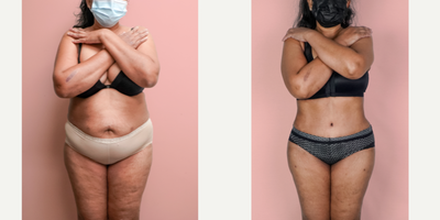 55-64 year old woman treated with Liposuction - This lovely patient requested help in improving her shape and removing the sagging skin from her abdomen. She was able to turn back the clock and look 30 years younger with a combination of tummy tuck and 360 liposuction.