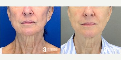 75 and up year old woman treated with Sofwave, Ultherapy - The patient is a 76-year-old female who had concerns about skin laxity on her lower face and neck. To address these concerns, the patient received a combination treatment of Sofwave and Ultherapy. The results shown are 10 months post-treatment.