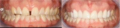 Closing Gap With Porcelain Veneers - Drummer for up and coming rock band wanted a better stage presence, but felt his smile held him back.  8 porcelain veneers made his teeth whiter, longer and with NO gap!  Only 2 visits to a fantastic new smile!