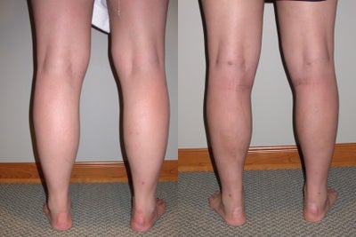 Liposuction of the ankles and calves - 31 year old preop and 4 months postop liposuction of ankles and calves. Patient complained of inability to wear boots due to her large calves.
