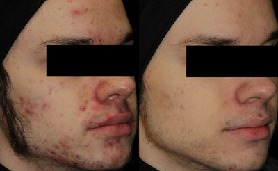 Man treated with AviClear - Man treated with AviClear
