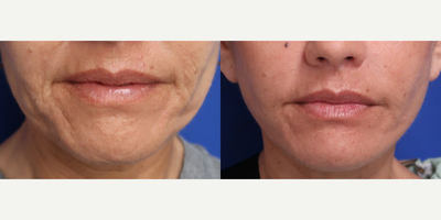 Woman treated with Facelift - Lifted and loving it!Check out these incredible before and after results from our FACEology LIFT treatment on a 46-year-old client.Non-invasive, pain-free, and totally transformative!