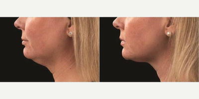 Woman treated with CoolSculpting - Woman treated with CoolSculpting