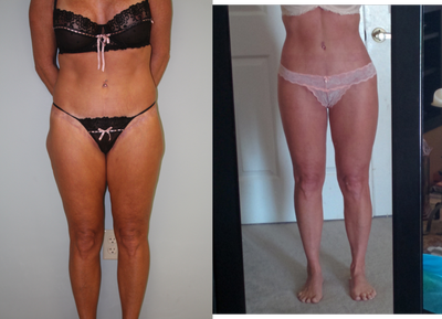 55year old lady with flat buttocks saddle bags and lax thighs - 55 year old lady presented following a lower body lift with supposed auto augmentation of the buttocks and spiral thigh lift done elsewhere. Her major concerns were the laxity of the upper thighs and saddle bag formation. I performed an extended spiral thigh lift with auto augmentation of the buttocks and hips as well as liposuction of the flanks, back and saddle bag areas with fat injections to the lower buttock areas.