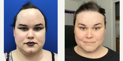 Patient treated with Cheek Augmentation, Facial Feminization Surgery, Rhinoplasty, Septoplasty, Transgender Facial Feminization  - 35 to 44 year-old female patient is 18 post-op from Facial Feminization surgery. Her procedures included: Placement of Tissue Expander for Flap with Forehead Lift and Orbital Bony Contour, Septorhinoplasty (closed) with Cartilage Grafts, Cheek Implants (small), Chin Reduction and Contour, Soft Tissue to Nasolabial Folds and PreJowl, Subnasal Lip Lift with Fat Augmentation to Lips and Full Submental Liposuction. Patient is 12 months post-op Remove Tissue Expander and Rotate Flap.