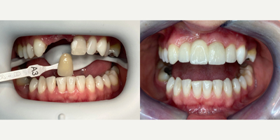 25-34 year old woman treated with Dental Bridge - We replaced the old dental bridge of our patient and applied whitening to the whole teeth.