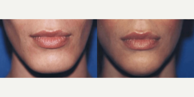 Woman treated with Genioplasty - Woman treated with Genioplasty