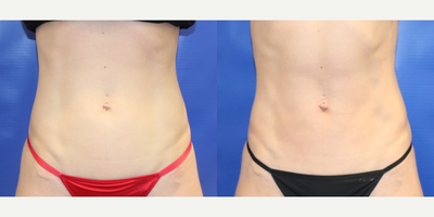 35-44 year old woman treated with CoolTone - Immediately after 4 Treatments of CoolTone
