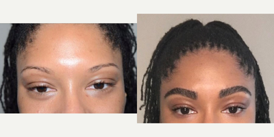 25-34 year old woman treated with Eyebrow Transplant - In this Black patient, the soft curl of her hair made it a bit easier to achieve a natural appearance with 650 grafts to the eyebrows.