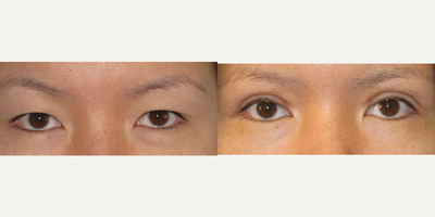 25-34 year old woman treated with Asian Eyelid Surgery - Asian blepharoplasty to create upper eyelid crease, The 'double eyelid' procedure