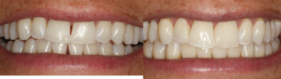 Bonding of Composite Material to Fill Spacing - 
	Following Invisalign treatment to straighten the patient's teeth, the patient chose to have composite material bonded to fill the undesired spacing which remained.
