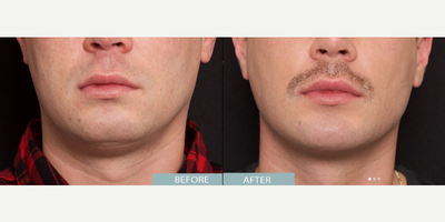 Man treated with Chin Implant - Man treated with Chin Implant