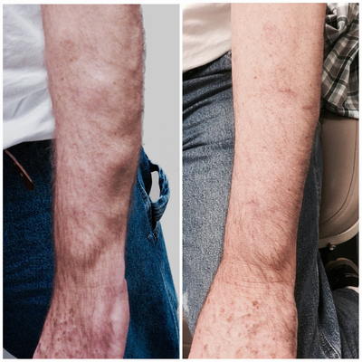 55-64 year old man treated with Lipoma Removal - Lipoma Removal