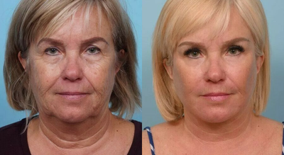65 year old woman treated with Facelift - This 65 year old patient was bothered by her jowling, heavy eyelids and the tone and texture of her skin. Dr. Balikian performed a Deep Plane Facelift, Neck lift, Temporal Extension Brow Lift, Upper Blepharoplasty, Lower Transconjunctival Blepharoplasty, Facial Fat transfer and CO2 Laser. Although it sounds like many procedures since they are all small areas they can be done at the same time. This allows for a natural-looking face that is in harmony.