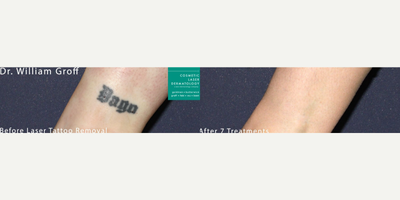 Woman treated with PicoWay - Laser treatment to remove tattoo by Dr. Groff