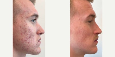 18-24 year old man treated with Accutane - This patient underwent an upper blepharoplasty to address sagging skin above the eyes. Before the procedure, the excess skin created a heavy, tired appearance. After the treatment, her eyes look noticeably more open and refreshed, with a smoother and more youthful contour. The results beautifully enhance her natural features, giving her a brighter and more rejuvenated look.