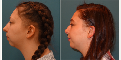 18-24 year old woman treated with Chin Implant and Rhinoplasty - 21 year old female presented with significant facial asymmetry after orthognathic surgery. She had a severely deviated nasal septum, breathing difficulties and inability to smell. She also had a recessed chin requiring augmentation with a chin implant. She underwent open rhinoplasty, septal repair and placement of 9mm chin implant