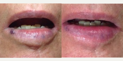 75 and up year old man treated with nd-Yag Laser - The nd-Yag works great for treating vascular lesions, including venous lakes (shown below) and cherry angiomas.