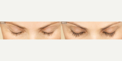 35-44 year old woman treated with Latisse - Natural luscious lashes in weeks! Latisse is the first and only FDA-approved lash growth serum for longer, thicker, fuller, and darker lashes!