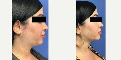 35-44 year old woman treated with Liposuction - SmartLipo of the neck.