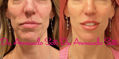Woman treated with Laser Peel - Our patient is in her 40's and is shown before and after two MicroLaserPeel treatments