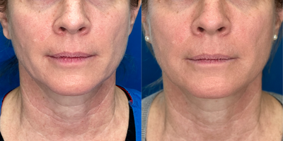 35-44 year old woman treated with Endolift, Nonsurgical Facelift, Nonsurgical Neck Lift, Skin Rejuvenation, Skin Tightening - Endolift Laser is an office procedure using a micro-fiber placed through tiny pin holes in the skin to stimulate your skin collagen, tighten lax tissue and contour unwanted jowl, cheek fold and neck fat.
