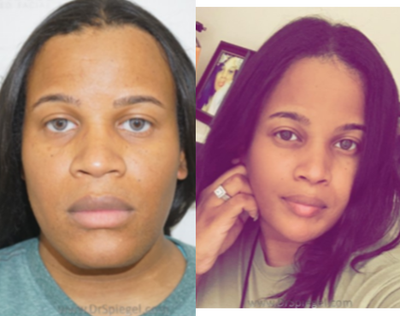 35-44 year old woman treated with V Line Surgery - Patient had Mandible Contouring 1 year ago.