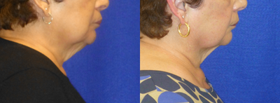 75 and up year old woman treated with CoolMini - Single day treatment for fat reduction and skin tightening at the chin and neck with CoolMini. Results were achieved in 1 month. To see results after 4 months, view the additional before and afters for this treatment.