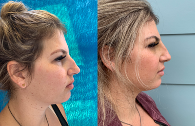 25-34 year old woman treated with Nonsurgical Nose Job - Threads - This patient wanted to decrease the bump on her nose, refine her tip and rotate her tip slightly upwards. With one Eurothread, her bump is gone. Minimal pain, swelling, and bruising.