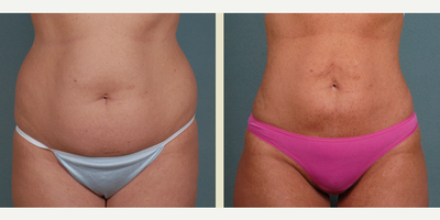 25-34 year old woman treated with Butt Augmentation - This 28-year-old patient underwent Liposuction to the abdomen, bra roll, upper and lower back, hips and flanks, during her cosmetic surgery procedure. 620cc of fat was transferred into each buttocks to further enhance the derriere. She is shown before and one year after her Brazilian Butt Lift procedure.