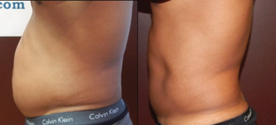35-44 year old man treated with UltraSlim - UltraSlimtreatments under cold light therapy. No pain. No vacuum tubs. No suction. No drugs, no surgery, no downtime. Can be done over the lunch break. 32 minutetreatment.