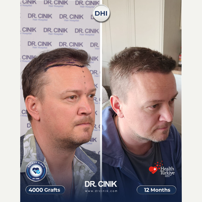 35-44 year old man treated with DHI Hair Transplant, Hair Loss Treatment, Hair Transplant - 4000 grafts DHI