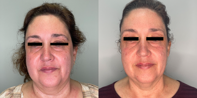 45-54 year old woman treated with Morpheus8, Kybella - pt treated with kybella and morpheus series of 3 treatments