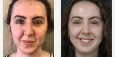 25-34 year old woman treated with Buccal Fat Removal - Buccal Fat Removal - 8 months post op