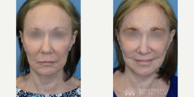 65-74 year old woman treated with Facelift Revision, Neck Lift - 66 year-old female with prior history of eyelid surgery who underwent revision upper blepharoplasty for eye rejuvenation.