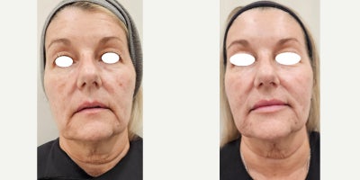 55-64 year old woman treated with IPL, Sylfirm X, Lip Fillers, Ultherapy, Alastin Skincare, Dysport - She started her Beauty Journey on January 31st 2024. She wanted to improve her skin quality in a natural and less invasive way. Her neck was a priority.We started with Ultherapy, 3 combined lasers (IPL plus vascular), Dysport, lip filler and then 3 SylfirmX face and neck treatments. She is using Alastin skincare