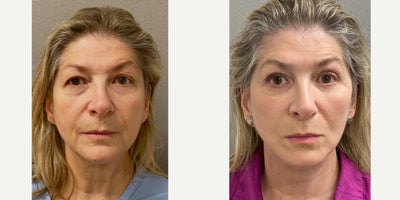64 yo s/p Deep plane facelift, browlift, upper and lower blepharoplasty - 64 yo s/p Deep plane facelift, browlift performed under local anesthesia with sedation in our on site AAAA certified operating suite.
