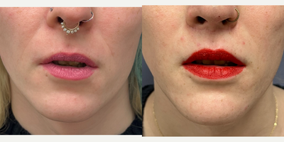 25-34 year old woman treated with Lip Lift, Lip Surgery - This is a young lady who underwent lip lift.