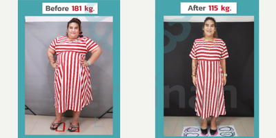 25-34 year old woman treated with Gastric Balloon - Sleeve gastrectomy, also known as the gastric sleeve surgery, is a highly effective bariatric procedure that has gained popularity worldwide for individuals struggling with obesity and seeking a permanent weight loss solution. This procedure involves removing approximately 80% of the stomach, leaving a tube-shaped stomach about the size of a banana. The result is a significant reduction in the amount of food that can be consumed at one time, helping patients achieve and maintain substantial weight loss.